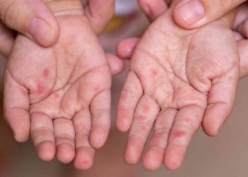 Casos De Virus Coxsackie - Salud Regia