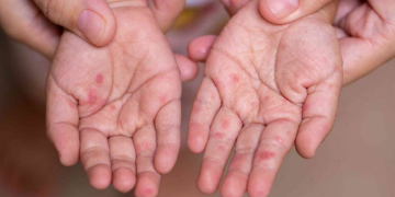 Casos De Virus Coxsackie - Salud Regia