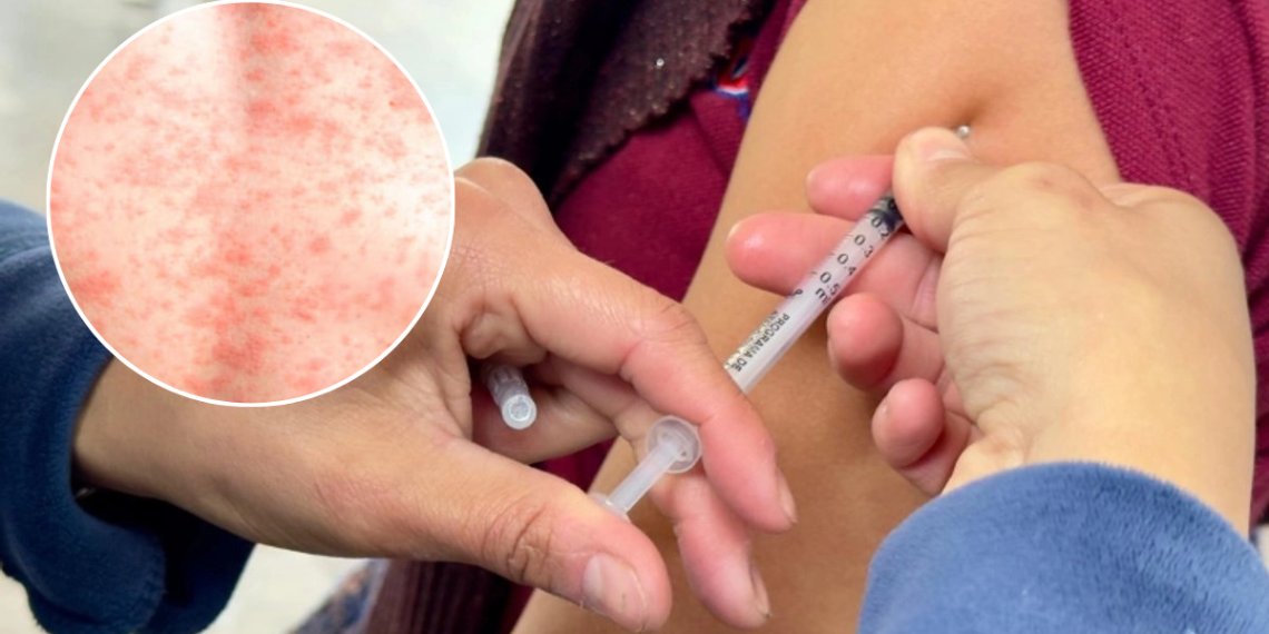 Casos De Sarampión - Salud Regia